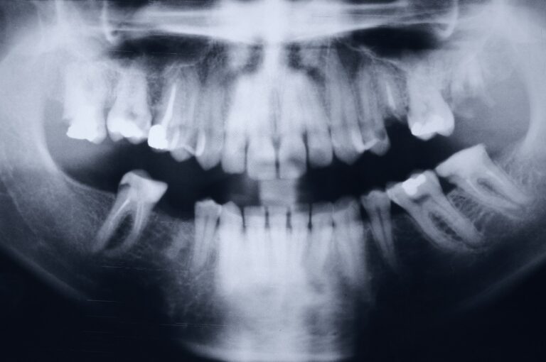 Stem Cells From Extracted Wisdom Teeth Are &lsquo;Medical Gold&rsquo; Capable Of Treating Many Diseases