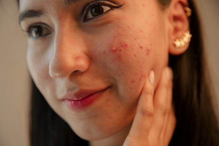 Smart Pimple Patch Can Clear Serious Acne In 7 Days